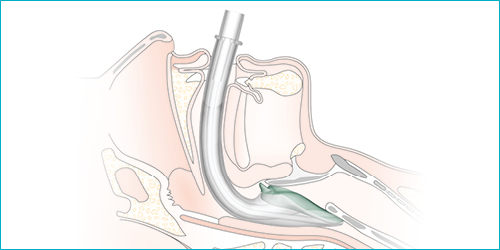 i-gel_anatomy_image