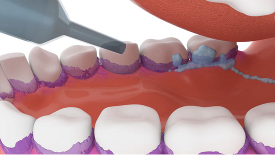 VAP development and prevention